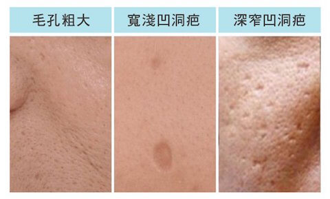 凹洞疤3類型-極光美學診所