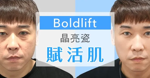 {Boldlift賦活肌} 案例－Kevin