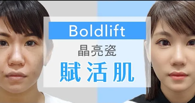 {Boldlift賦活肌} 案例－小敏
