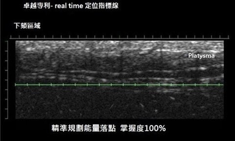 美國音波拉提推薦-超音波即時影像