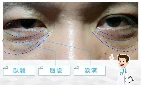 眼周老化-臥蠶手術-眼袋手術-填補淚溝