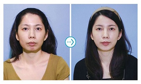 音波拉皮案例-極光美學醫美診所