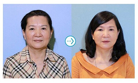 音波拉皮案例-極光美學醫美診所