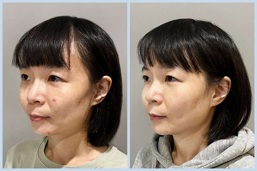TC05_皮秒蜂巢BA (2)