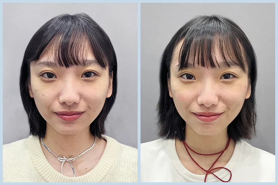 TY03_水光針BA (2)