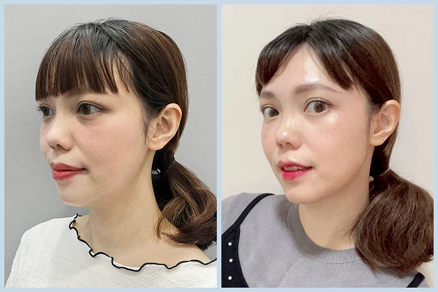 TY05_水光針BA-09