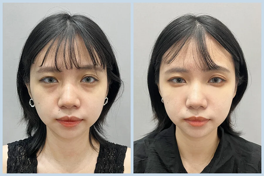 黑眼圈改善案例分享