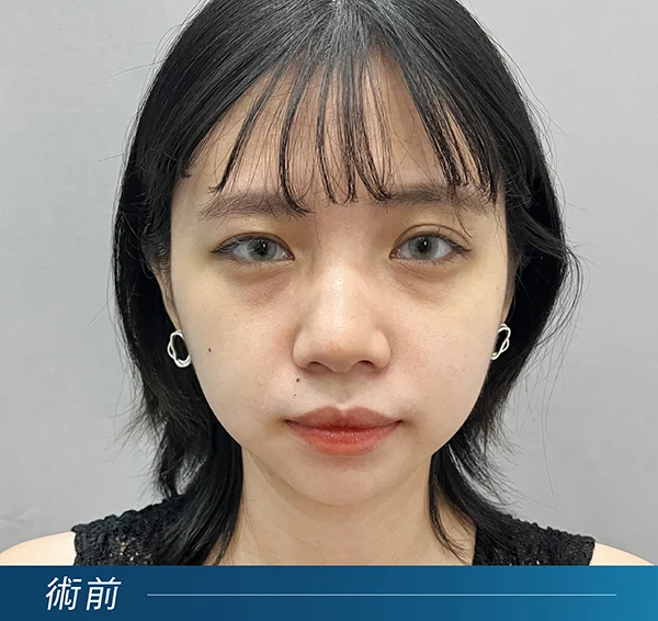 黑眼圈治療前