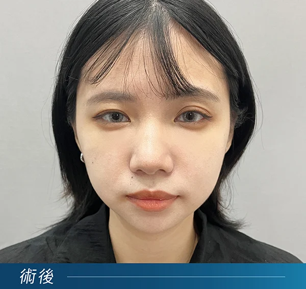 黑眼圈治療後