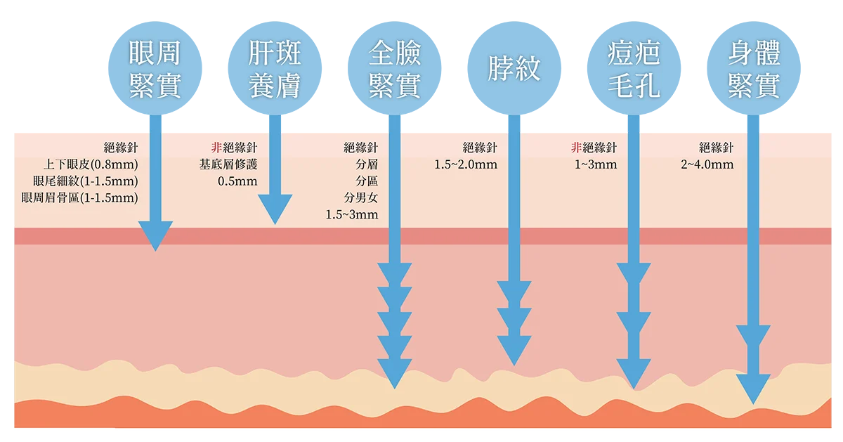 極光美學診所-神比微針電波VIRTUE-RF-治療深度效果痘疤、肝斑、毛孔_升級